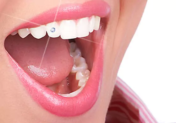 Tooth Jewellery Service at Impressionz Dental Care